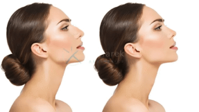 Nose Job