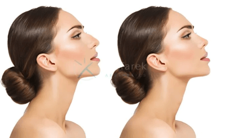 Nose Job