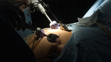 How Gastric Bypass Surgery Helps Manage Type 2 Diabetes