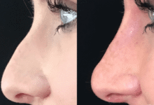 Rhinoplasty