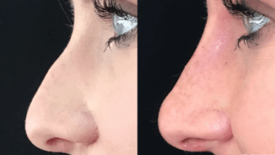Rhinoplasty