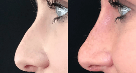 Rhinoplasty